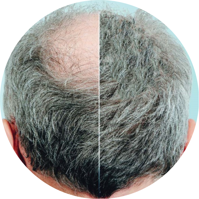 Before and after comparison of a man with male pattern baldness, showing significant hair regrowth after QR678® Neo treatment in Canada.