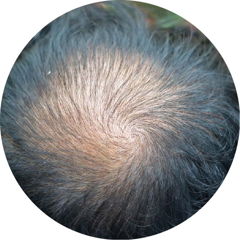 A close-up of a thinning crown, a common sign of male pattern baldness that QR678® Neo effectively treats in Canada.