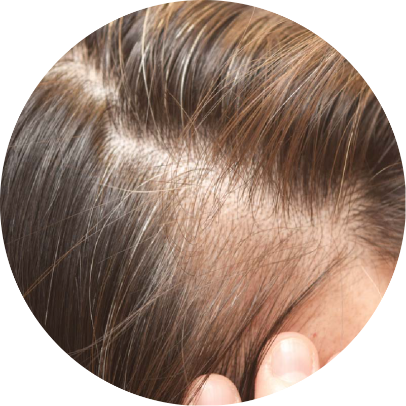 A woman experiencing thinning hair and a visible scalp, one of the key hair loss concerns that QR678® Neo effectively treats in Canada.