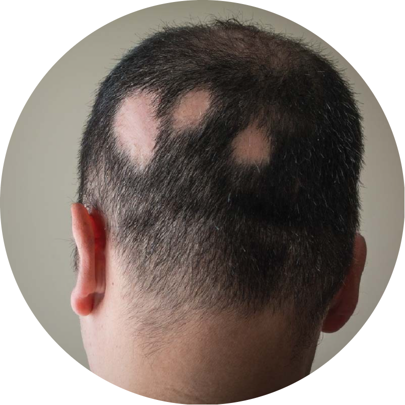 A male patient with patchy hair loss due to alopecia areata, a condition that QR678® Neo effectively treats by promoting natural hair regrowth in Canada