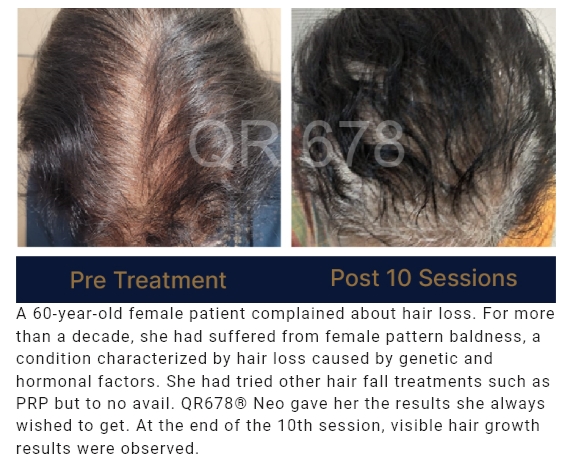 Before and after results of QR678® Neo treatment showing significant hair regrowth after 8 sessions for a female patient with female pattern baldness in Canada.