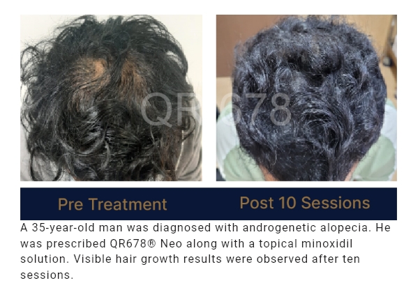 Before and after results of QR678® Neo treatment showing significant hair regrowth after 10 sessions for a patient with severe hair loss in Canada.